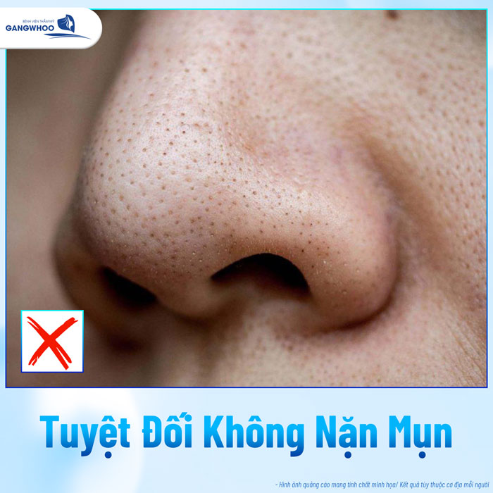 Cách trị mụn đầu đen sau khi nâng mũi hiệu quả