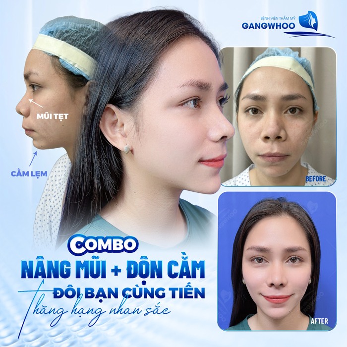 Nâng cao đầu mũi là gì? Phương pháp này có phù hợp với những trường hợp nào?