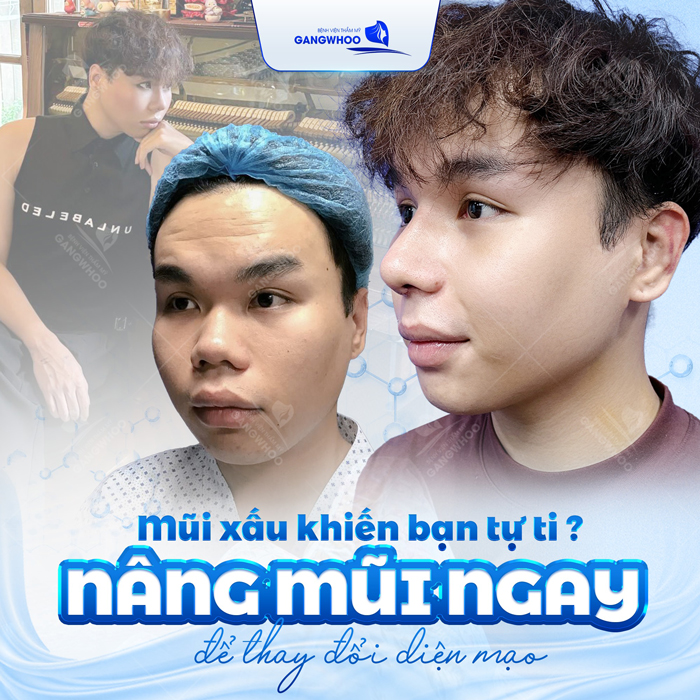 Nâng cao đầu mũi là gì? Phương pháp này có phù hợp với những trường hợp nào?