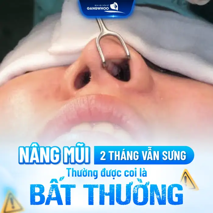 Nâng Mũi 2 Tháng Vẫn Sưng Có Nguy Hiểm Không? Cách Giảm Sưng