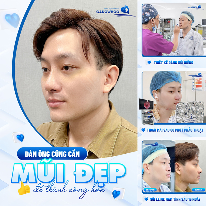 Nâng mũi bán cấu trúc 4D là gì? Có nên lựa chọn?