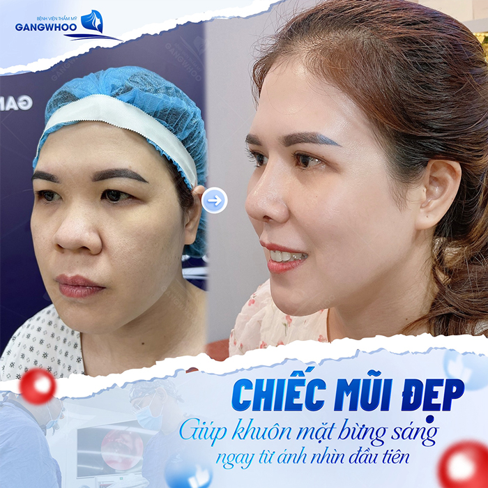 Nâng mũi bán cấu trúc 4D là gì? Có nên lựa chọn?