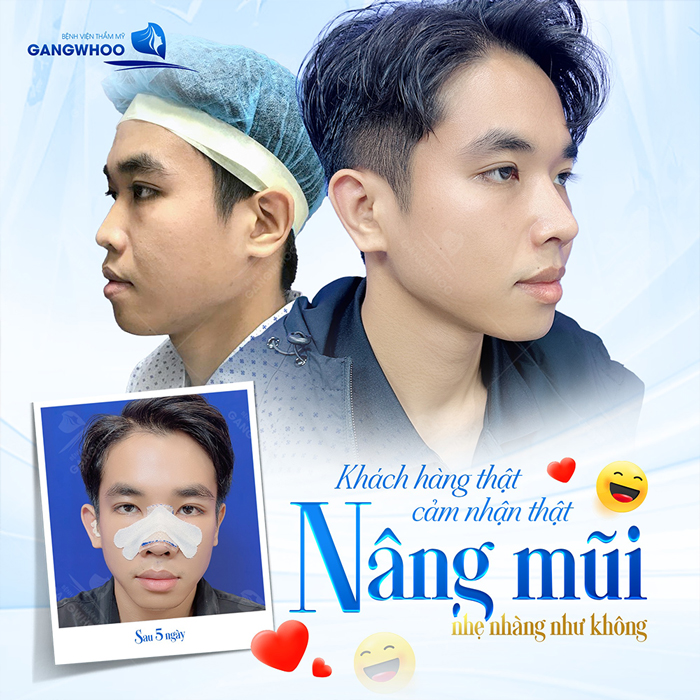 Nâng mũi bán cấu trúc 4D là gì? Có nên lựa chọn?