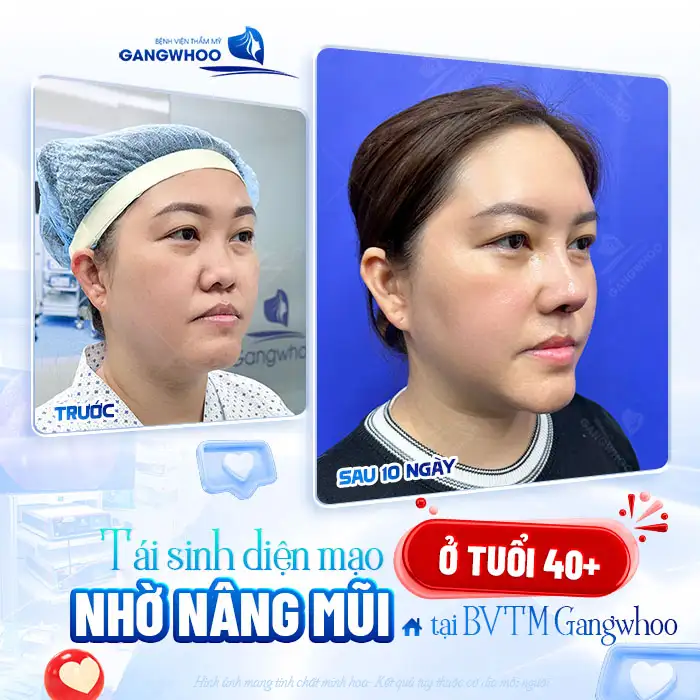 Nâng mũi chỉ sinh học là gì và có hiệu quả ra sao?