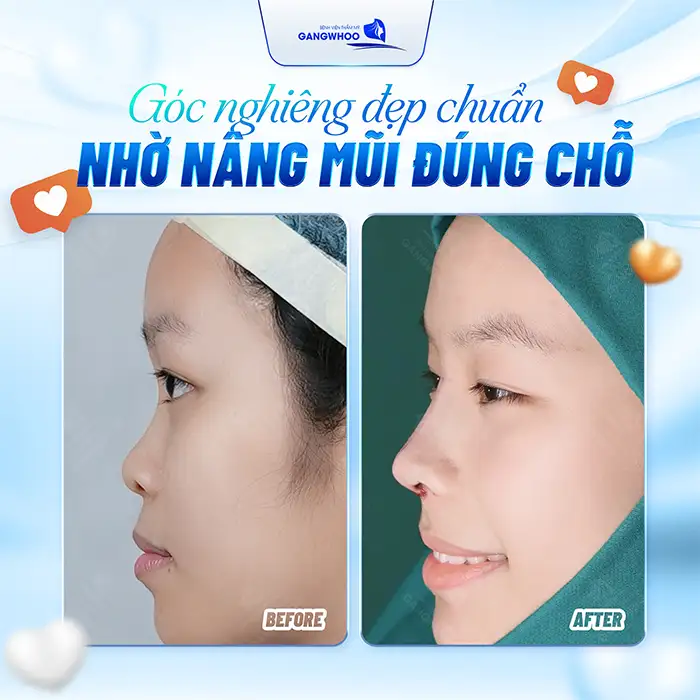 Nâng mũi chỉ sinh học là gì và có hiệu quả ra sao?