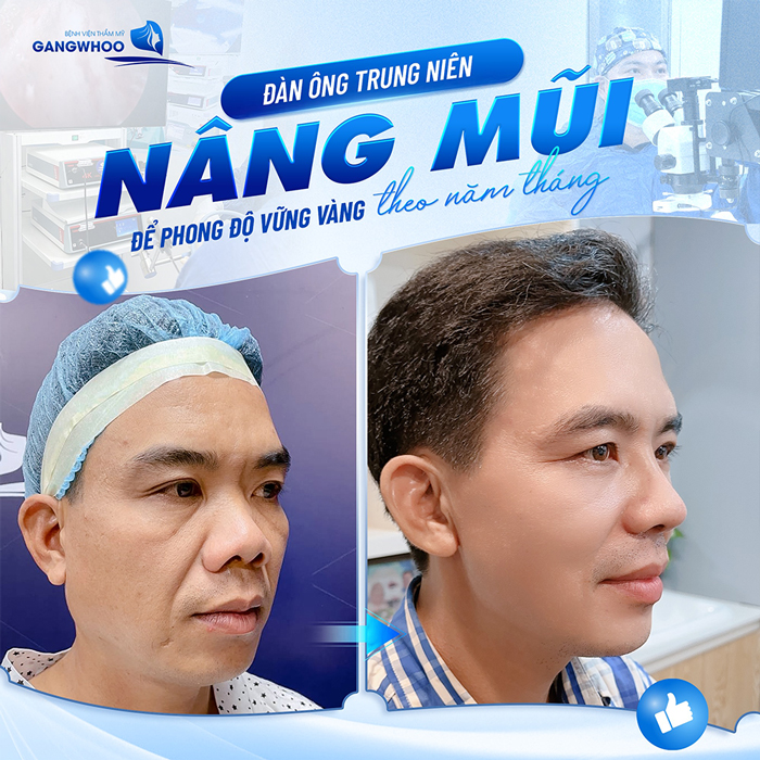 Nâng mũi chỉ xoắn kép là gì? Phương pháp này có ưu điểm gì so với kỹ thuật khác?