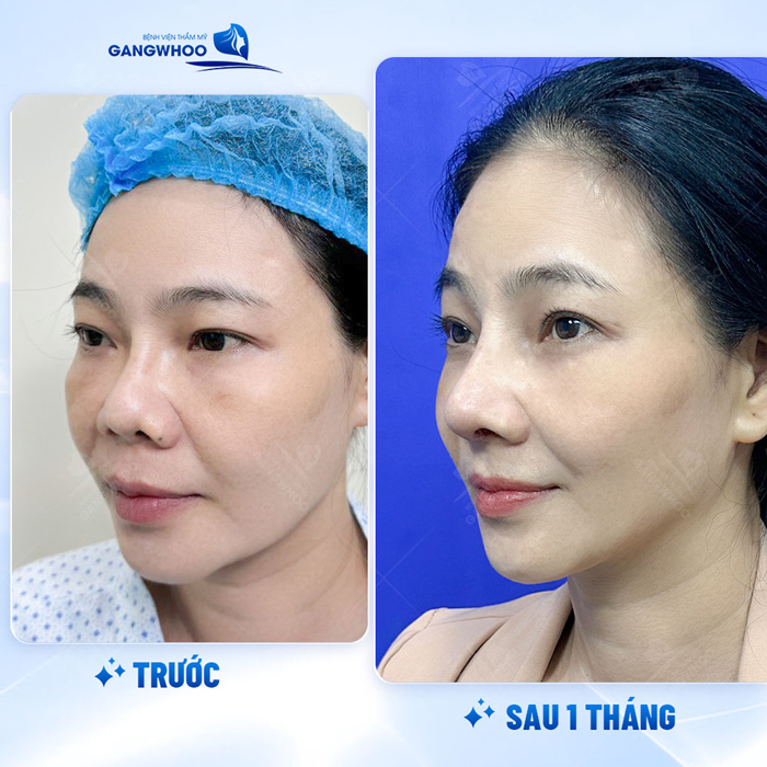 Nâng mũi chỉ xoắn kép là gì? Phương pháp này có ưu điểm gì so với kỹ thuật khác?