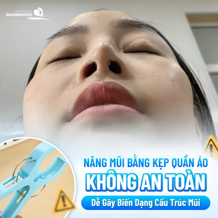 Nâng mũi bằng kẹp quần áo có an toàn không? Có thể nâng cao sống mũi không 1 Nâng mũi bằng kẹp quần áo có an toàn không? Có thể nâng cao sống mũi không