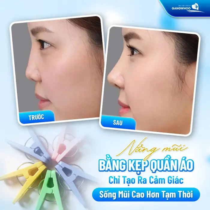 Nâng mũi bằng kẹp quần áo có an toàn không? Có thể nâng cao sống mũi không 2 Nâng mũi bằng kẹp quần áo có an toàn không? Có thể nâng cao sống mũi không