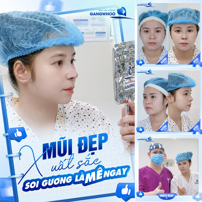 Nâng mũi bằng phương pháp nào an toàn nhất? Nên chọn theo tiêu chí nào?