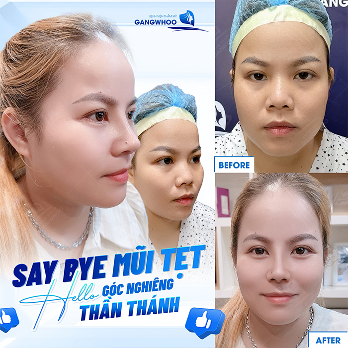 Nâng mũi bằng sụn vách ngăn là gì? Có ưu điểm gì so với các loại sụn khác?