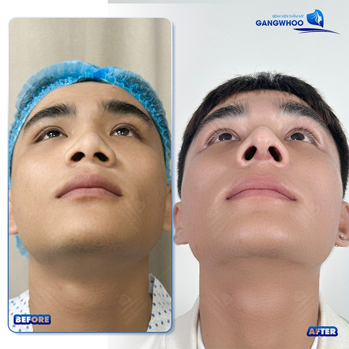 Nâng mũi bằng sụn vách ngăn là gì? Có ưu điểm gì so với các loại sụn khác?