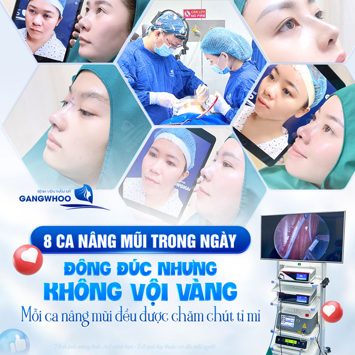 Nâng mũi bao lâu thì bị tụt sụn? Cách phòng tránh trường hợp tụt sụn sau nâng mũi 4 Nâng mũi bao lâu thì bị tụt sụn? Cách phòng tránh trường hợp tụt sụn sau nâng mũi