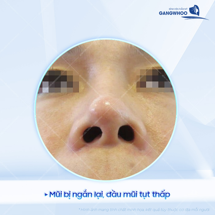 Nâng mũi bao lâu thì bị tụt sụn? Cách phòng tránh trường hợp tụt sụn sau nâng mũi 2 Nâng mũi bao lâu thì bị tụt sụn? Cách phòng tránh trường hợp tụt sụn sau nâng mũi