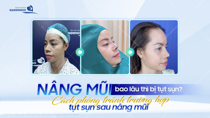 Nâng mũi bao lâu thì bị tụt sụn? Cách phòng tránh trường hợp tụt sụn sau nâng mũi 1 Nâng mũi bao lâu thì bị tụt sụn? Cách phòng tránh trường hợp tụt sụn sau nâng mũi