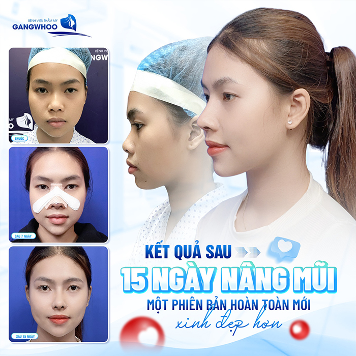 Nâng mũi sau bao lâu thì bình thường? Nên làm gì cho vết thương nhanh hồi phục