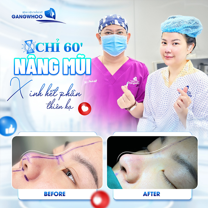 Nâng mũi sau bao lâu thì bình thường? Nên làm gì cho vết thương nhanh hồi phục
