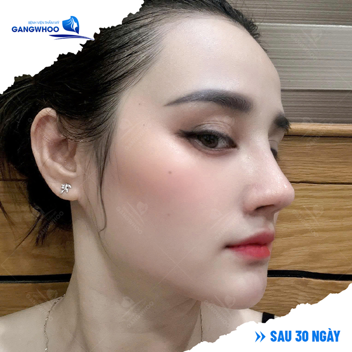 Nâng mũi sau bao lâu thì bình thường? Nên làm gì cho vết thương nhanh hồi phục