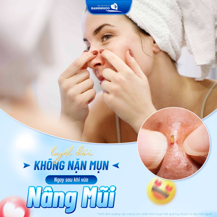 Nâng mũi bao lâu thì được nặn mụn? Có nên nặn mụn sau nâng mũi không?