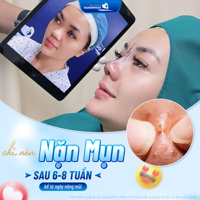 Nâng mũi bao lâu thì được nặn mụn? Có nên nặn mụn sau nâng mũi không?