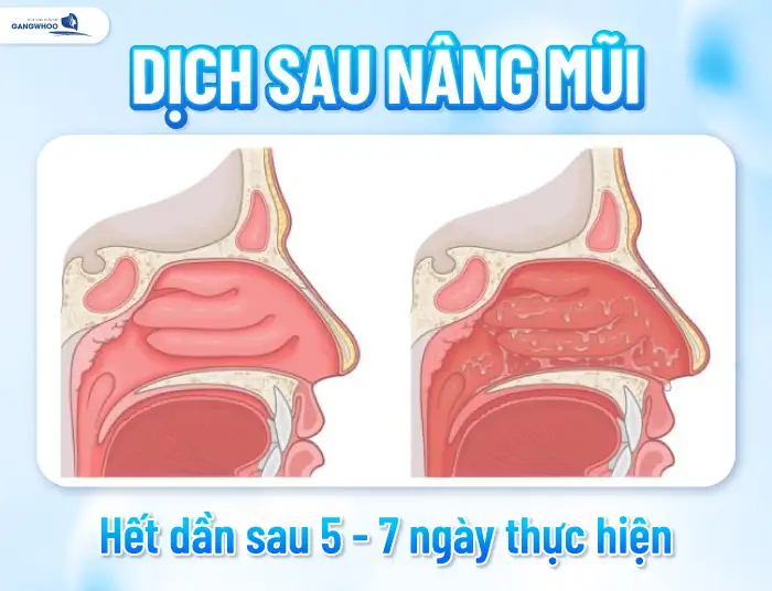 Nâng mũi bao lâu thì hết dịch? Cách nào để tránh bị tích tụ dịch?