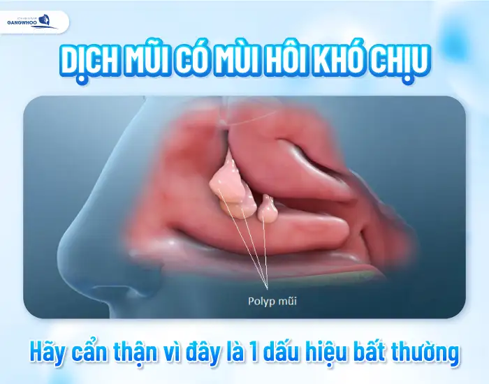 Nâng mũi bao lâu thì hết dịch? Cách nào để tránh bị tích tụ dịch?