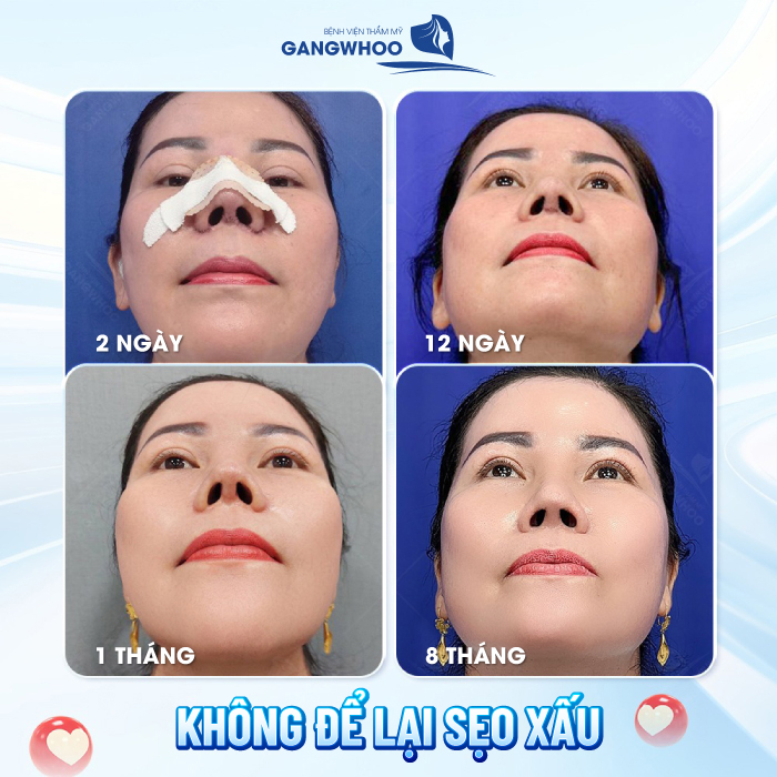 Nâng mũi bao lâu thì lành hẳn? Cách chăm sóc mũi nhanh lành