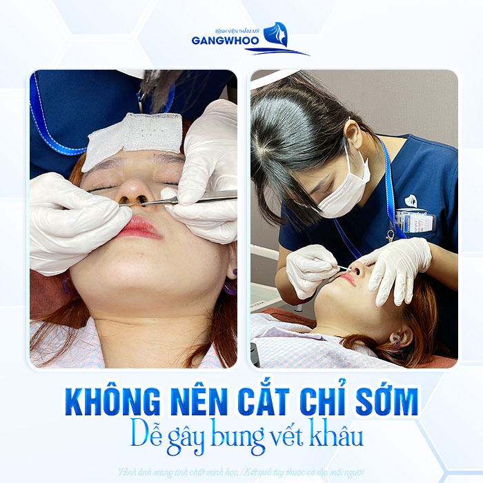 Nâng mũi bao nhiêu ngày cắt chỉ được? Cắt chỉ sớm có sao không?