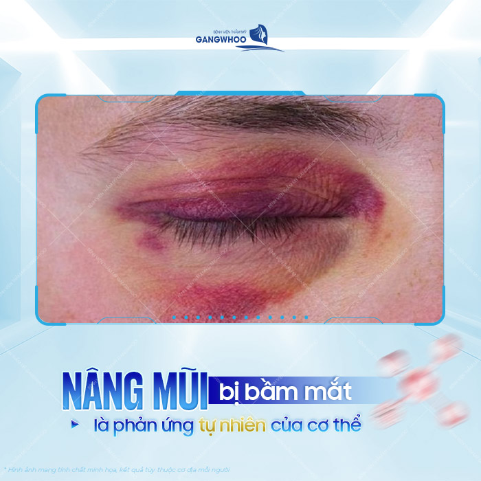Nâng mũi bị bầm mắt có nguy hiểm không? Cách xử lý như thế nào? 1 Nâng mũi bị bầm mắt có nguy hiểm không? Cách xử lý như thế nào?
