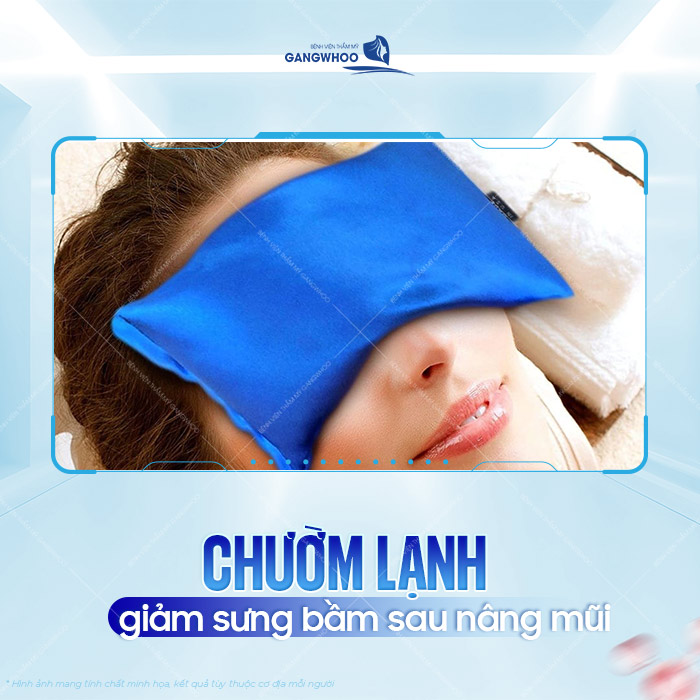 Nâng mũi bị bầm mắt có nguy hiểm không? Cách xử lý như thế nào? 2 Nâng mũi bị bầm mắt có nguy hiểm không? Cách xử lý như thế nào?