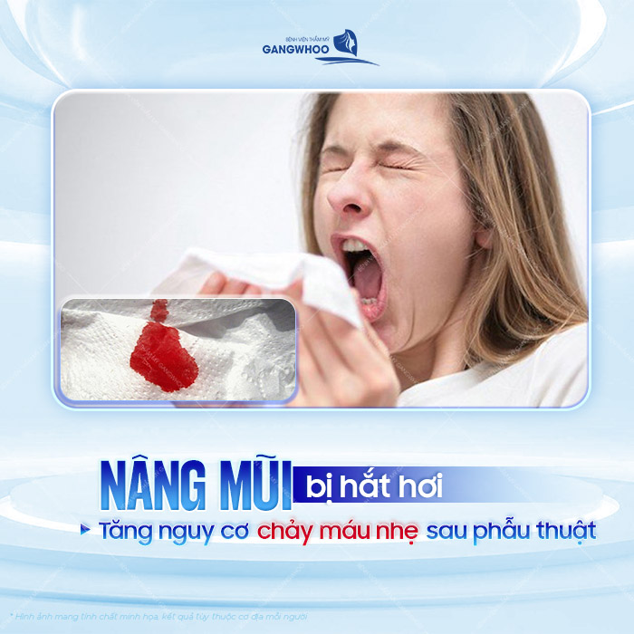 Nâng mũi bị hắt hơi có ảnh hưởng đến vết thương không? Nhưng lưu ý khi hắt xì 1 Nâng mũi bị hắt hơi có ảnh hưởng gì đến vết thương không? Nhưng lưu ý khi hắt xì