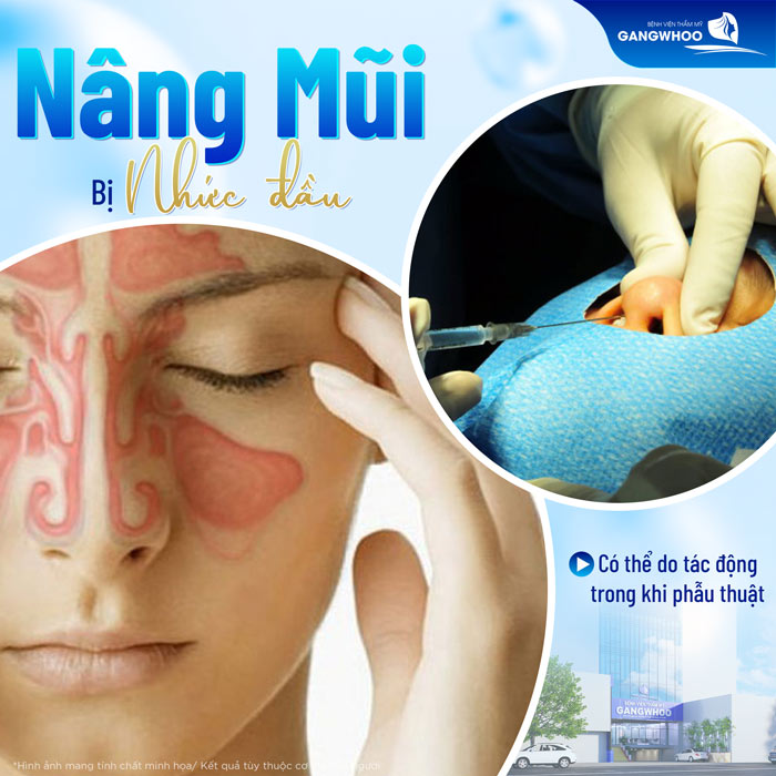 Nâng mũi bị nhức đầu có nguy hiểm không? Nguyên nhân do đâu?