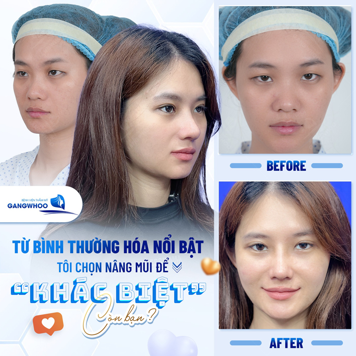 Nâng mũi cao tây là gì? Có phù hợp với dáng mũi người Việt không?