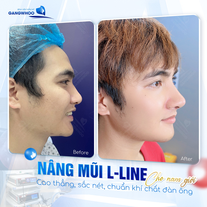 Nâng mũi cao tây là gì? Có phù hợp với dáng mũi người Việt không?