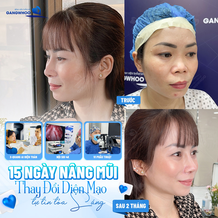 Nâng mũi cao tự nhiên, an toàn bằng phương pháp nào?