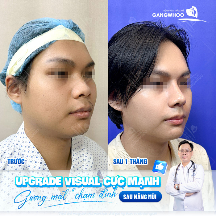 Nâng mũi cấu trúc 4D siêu âm là gì? Có những ưu điểm gì?