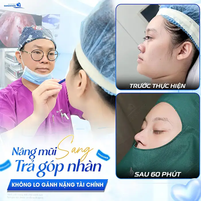 Nâng mũi cấu trúc bao lâu thì mũi gom lại ổn định? Cách chăm sóc ra sao?