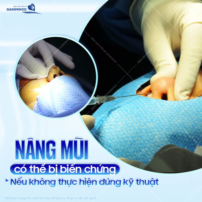 Nâng mũi chỉ có biến chứng không? Có nên lựa chọn phương pháp nâng mũi bằng chỉ?