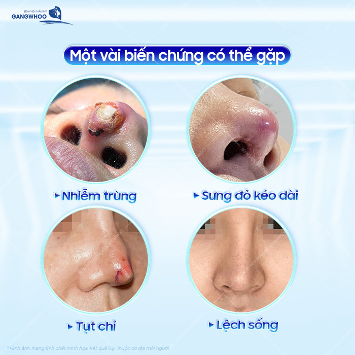 Nâng mũi chỉ có biến chứng không? Có nên lựa chọn phương pháp nâng mũi bằng chỉ?