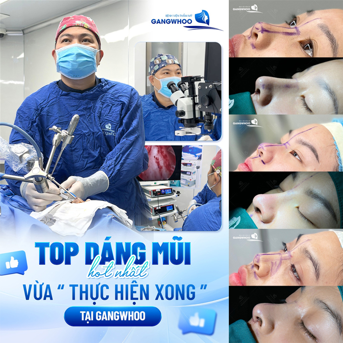 Nâng mũi có an toàn không? Có nên thực hiện nâng mũi không?