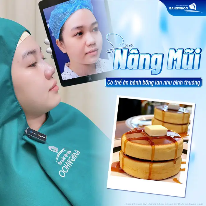Sau khi nâng mũi có được ăn bánh bông lan không? Có cần lưu ý gì không?
