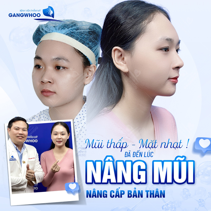 Nâng mũi có thay đổi khuôn mặt không? Mức độ thay đổi như thế nào để vẫn giữ được vẻ tự nhiên?