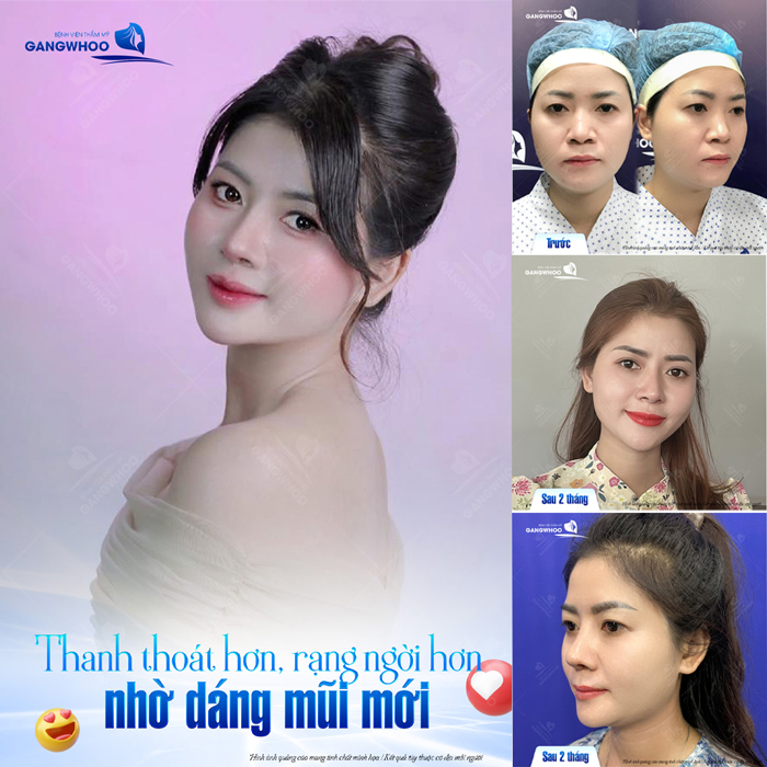 Nâng mũi có thay đổi khuôn mặt không? Mức độ thay đổi như thế nào để vẫn giữ được vẻ tự nhiên?