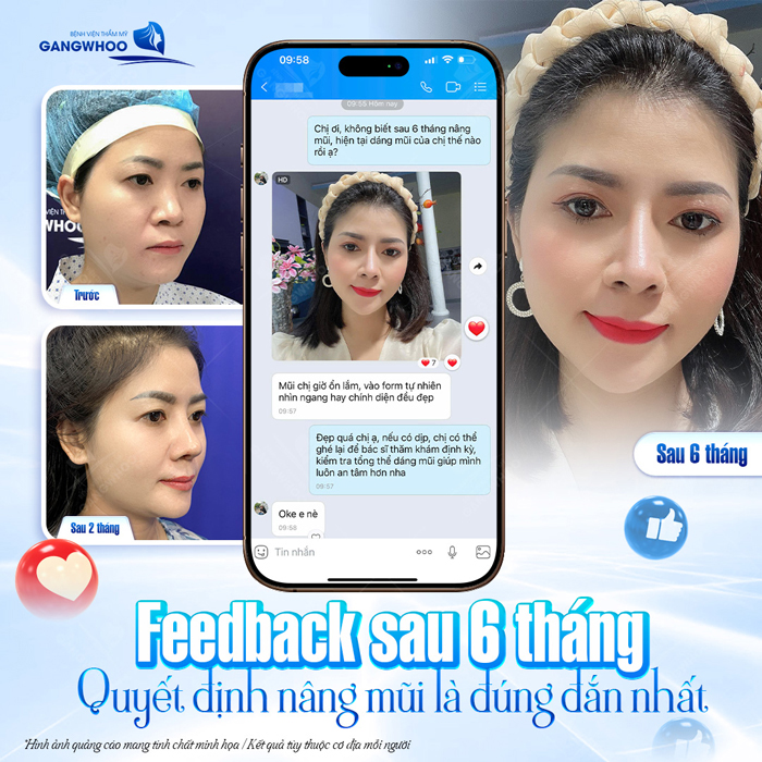 Nâng mũi demi 5D là gì? Có gì khác biệt so với các phương pháp khác?