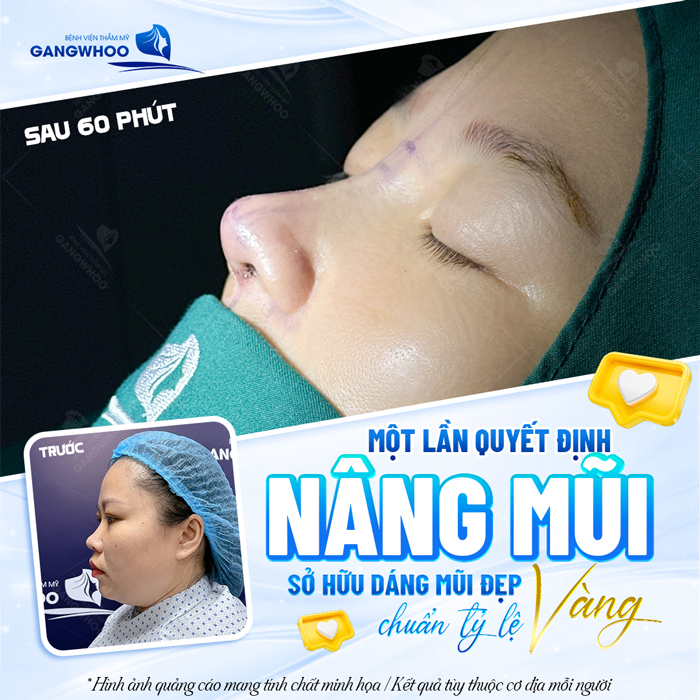 Nâng mũi demi 5D là gì? Có gì khác biệt so với các phương pháp khác?