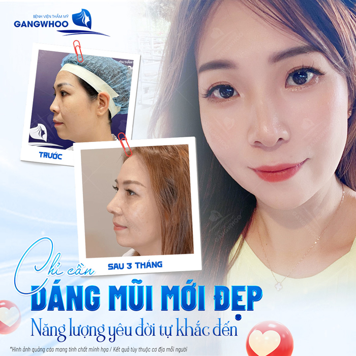 Nâng mũi gây tê hay mê? Nên lựa chọn phương pháp nào