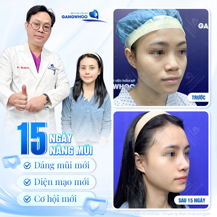 Nâng mũi High Line Nanocell là gì? Có những điểm nổi bật nào?