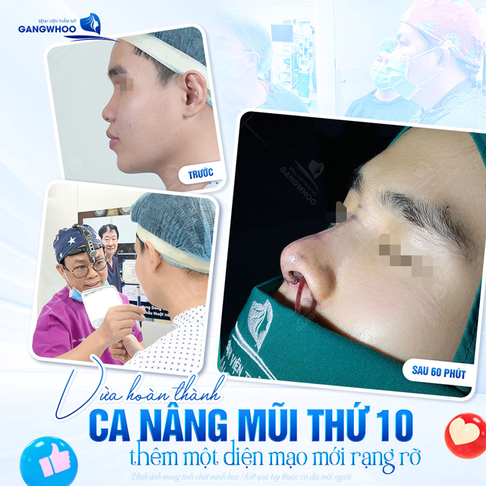 Nâng mũi L Line cho nam có gì khác biệt so với nâng mũi cho nữ?