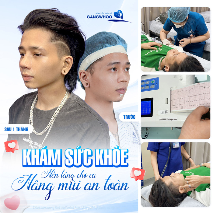 Nâng mũi L Line cho nam có gì khác biệt so với nâng mũi cho nữ?