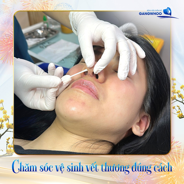 Nâng mũi Megaderm được bao lâu?